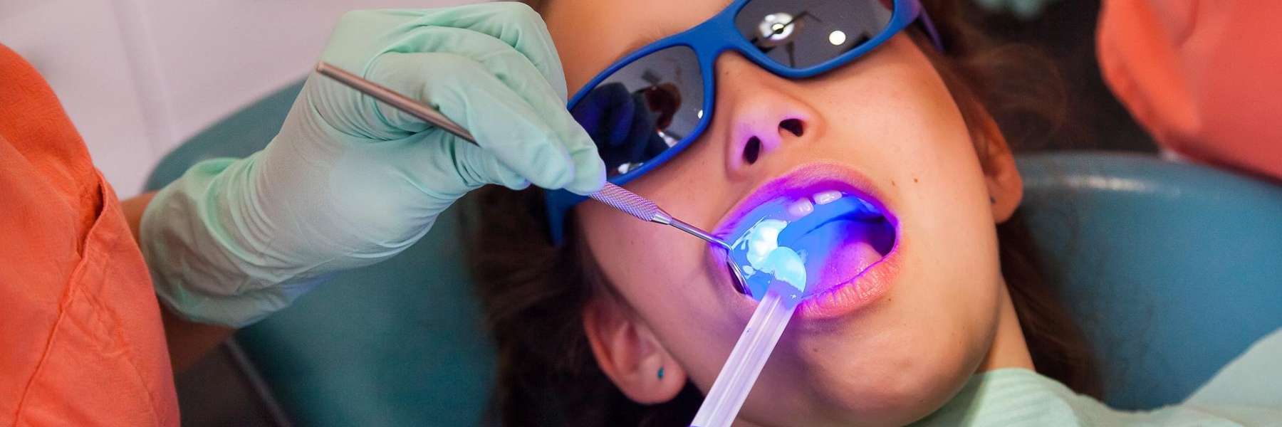 Dental Sealants | Dentist