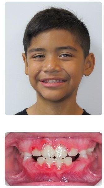 Interceptive-Orthodontics-Underbite-and-crossbite-After-Image