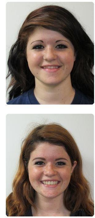 Surgical-Orthodontics-After-Image