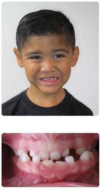 Interceptive-Orthodontics-Underbite-and-crossbite-Before-Image