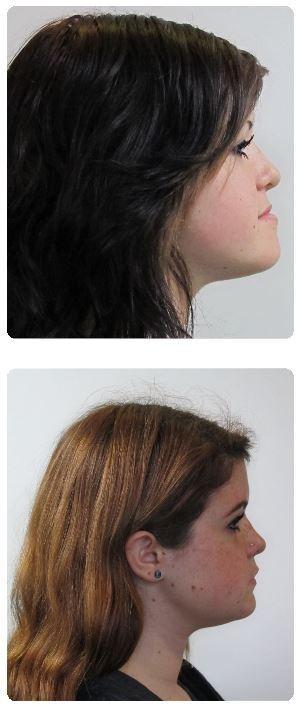 Surgical-Orthodontics-Before-Image